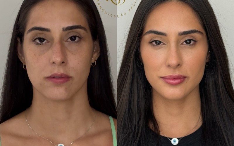 Deniziane, do BBB 24, revela resultado de harmonização facial e revela: