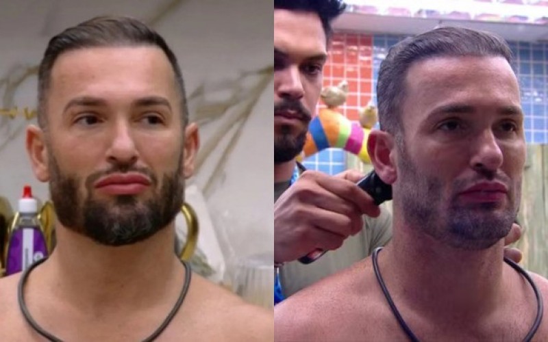 Diego Hypolito fez transplante capilar antes do BBB 25; médico conta detalhes do procedimento