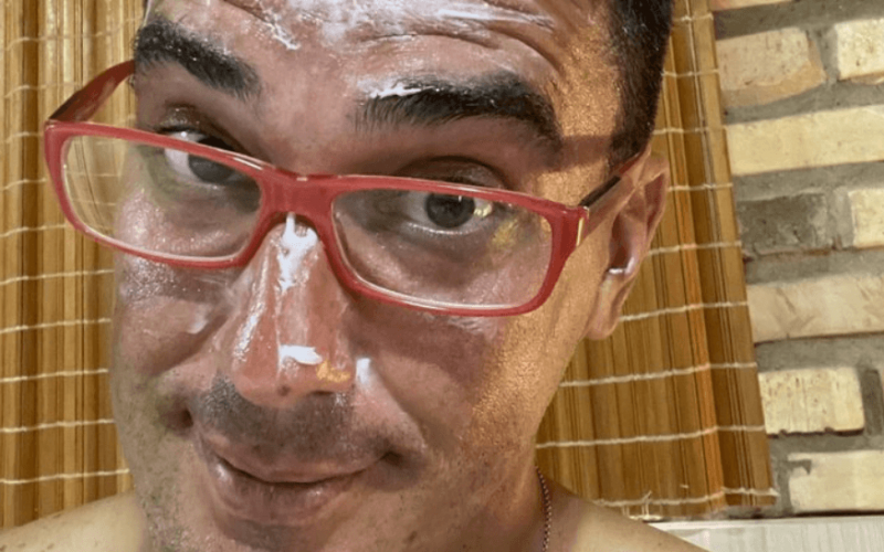 No Limite: André Marques faz desbafo sincero sobre gravações e mostra rosto queimado: "Apresentador também sofre"